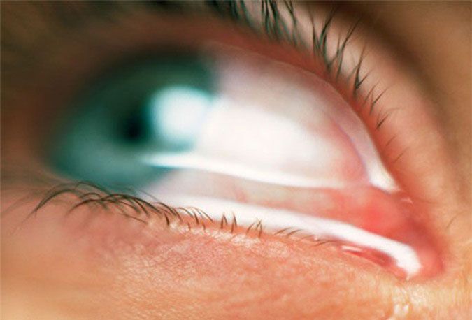 Các bệnh về mắt thường gặp hiện nay
